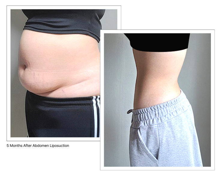 Liposucción de abdomen 360° grados result - 365mc