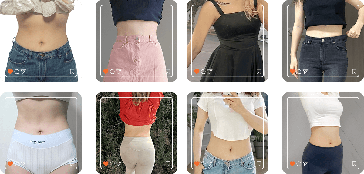 Abdomen liposuction before and after results - 365mc patients