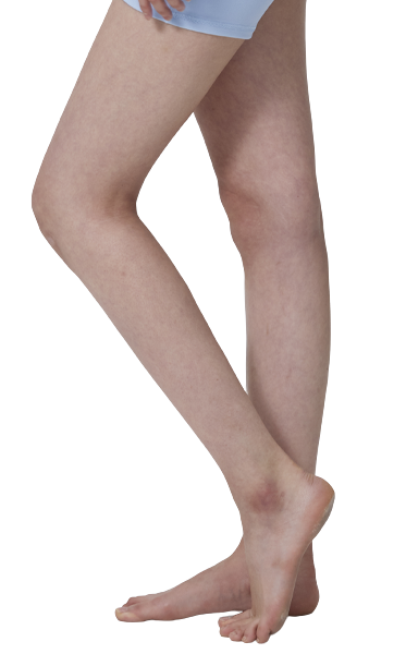 Calf liposuction treatment area - 365mc