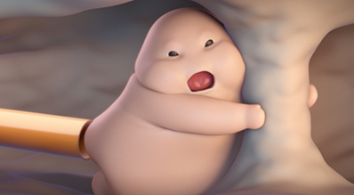 Inducción de descarga de grasa