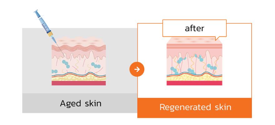 Skin Booster procedure illustration